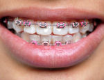 dental braces