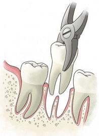 Tooth Extraction