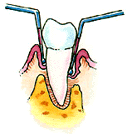 Advanced Periodontitis