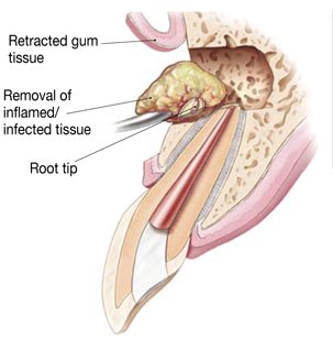 Apicoectomy