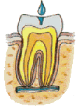 dental sealants