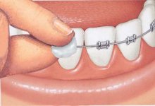 dental wax for braces