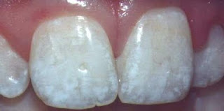 fluorosis