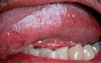 Oral Hairy Leukoplakia