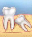 impacted wisdom teeth