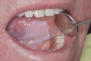 Oral Leukoplakia