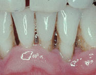 Periodontitis