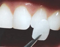 porcelain veneers