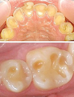 Tooth Erosion