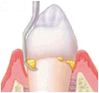 Tooth Scaling