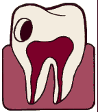 Tooth Decay