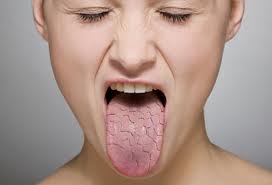 Dry Mouth - Xerostomia