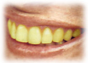 Yellow Teeth